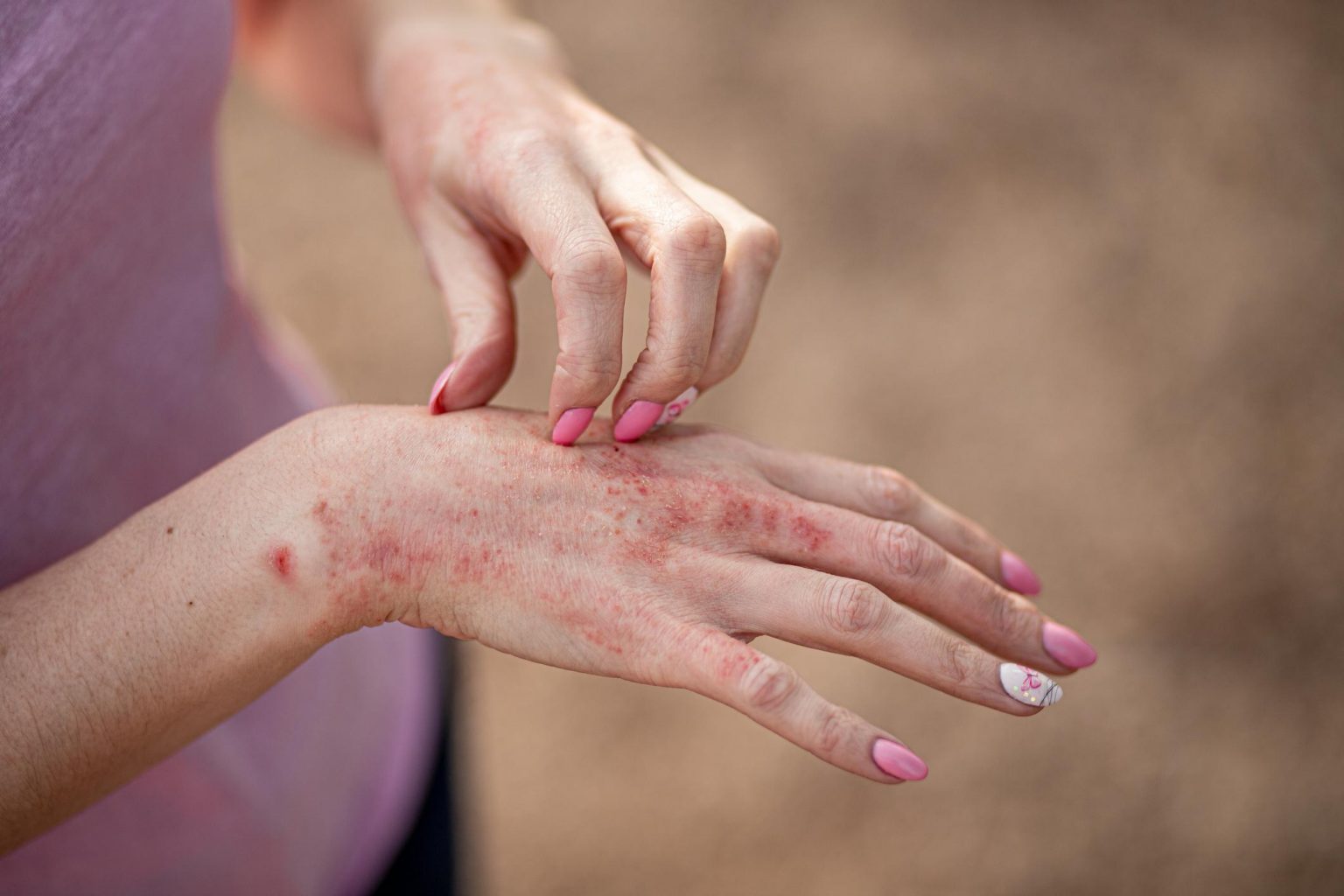 Le psoriasis, une maladie discrète de l'intérieur, mais pas de l'extérieur (istock)